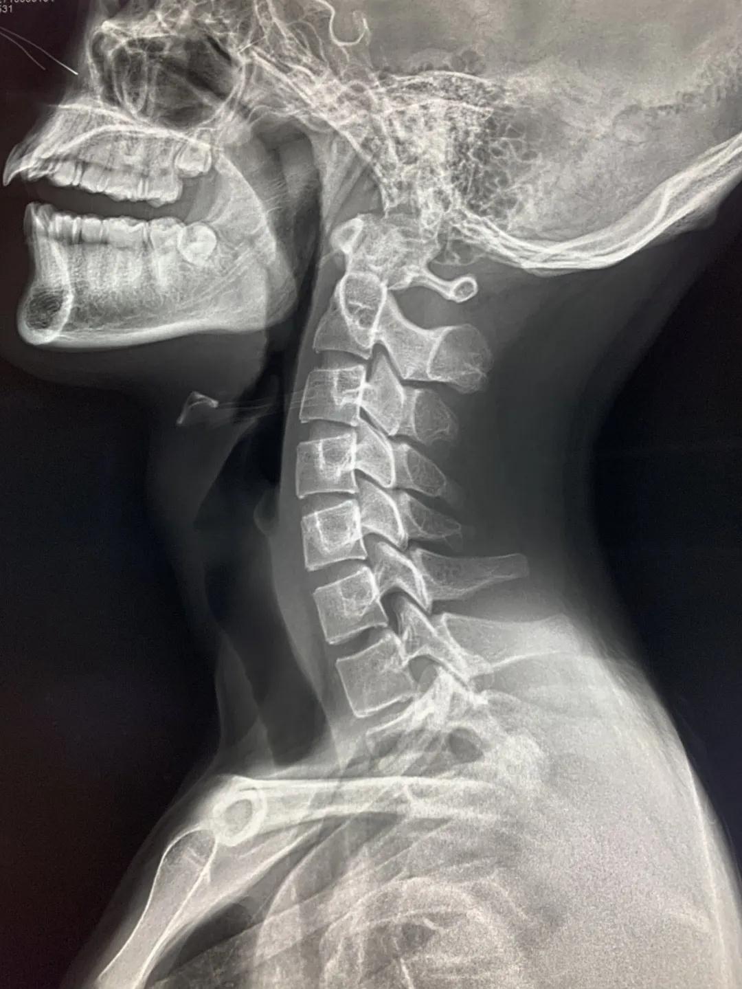 7.颈椎的形态-基础医学-医学
